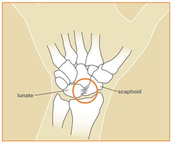 Scapholunate Ligament