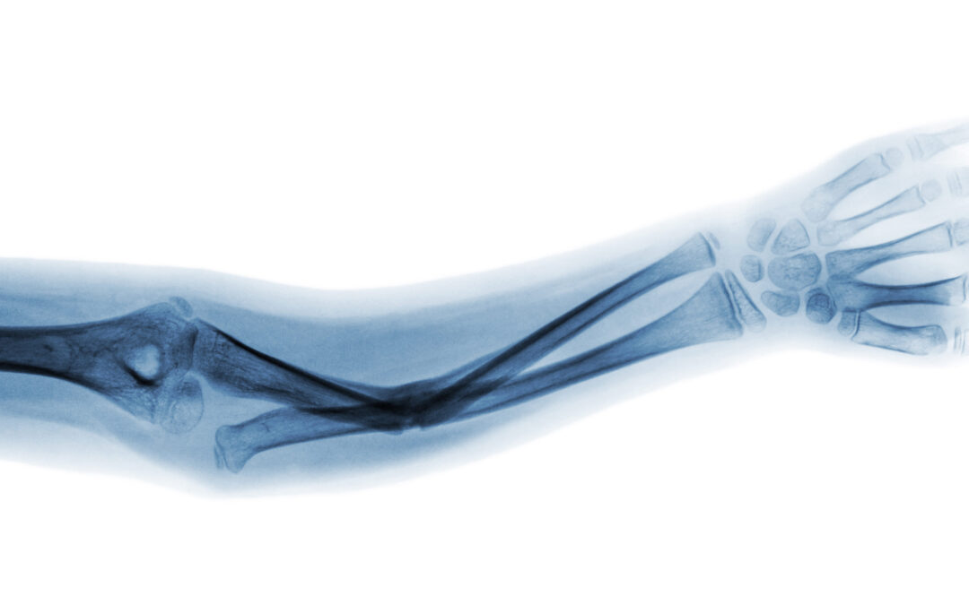 Possible causes and symptoms of a broken elbow