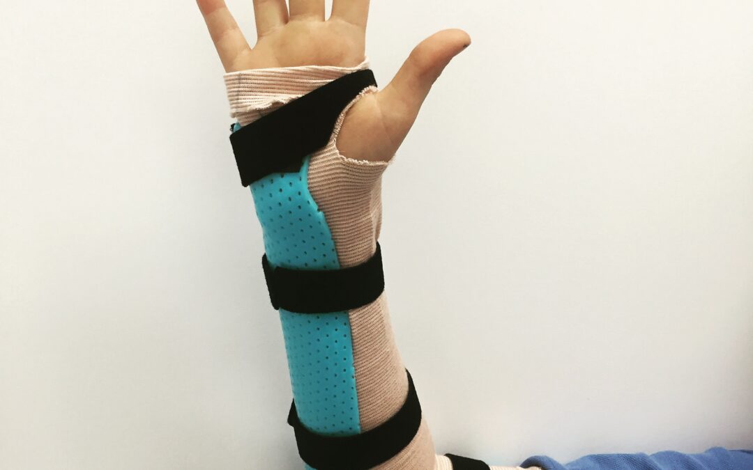 What is thermoplastic splinting?