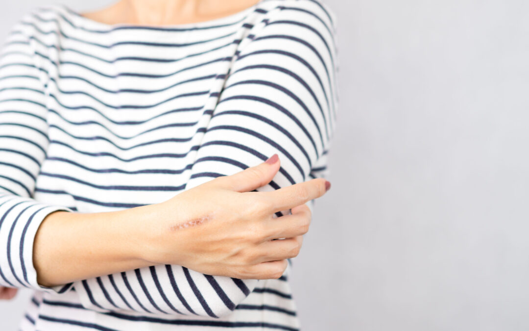 How to reduce scarring after recovering from a wound on the hand