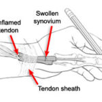 DeQuervain’s Syndrome – Hand Therapy Group