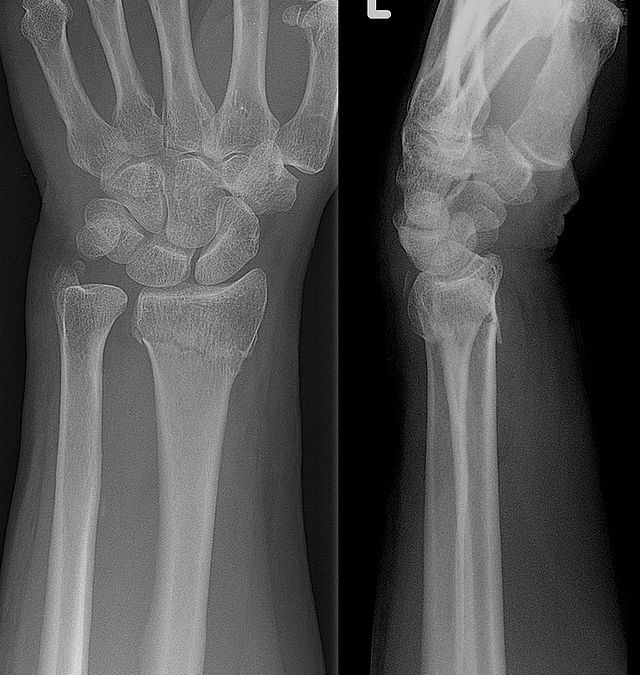 Broken Wrist (distal radius fracture)