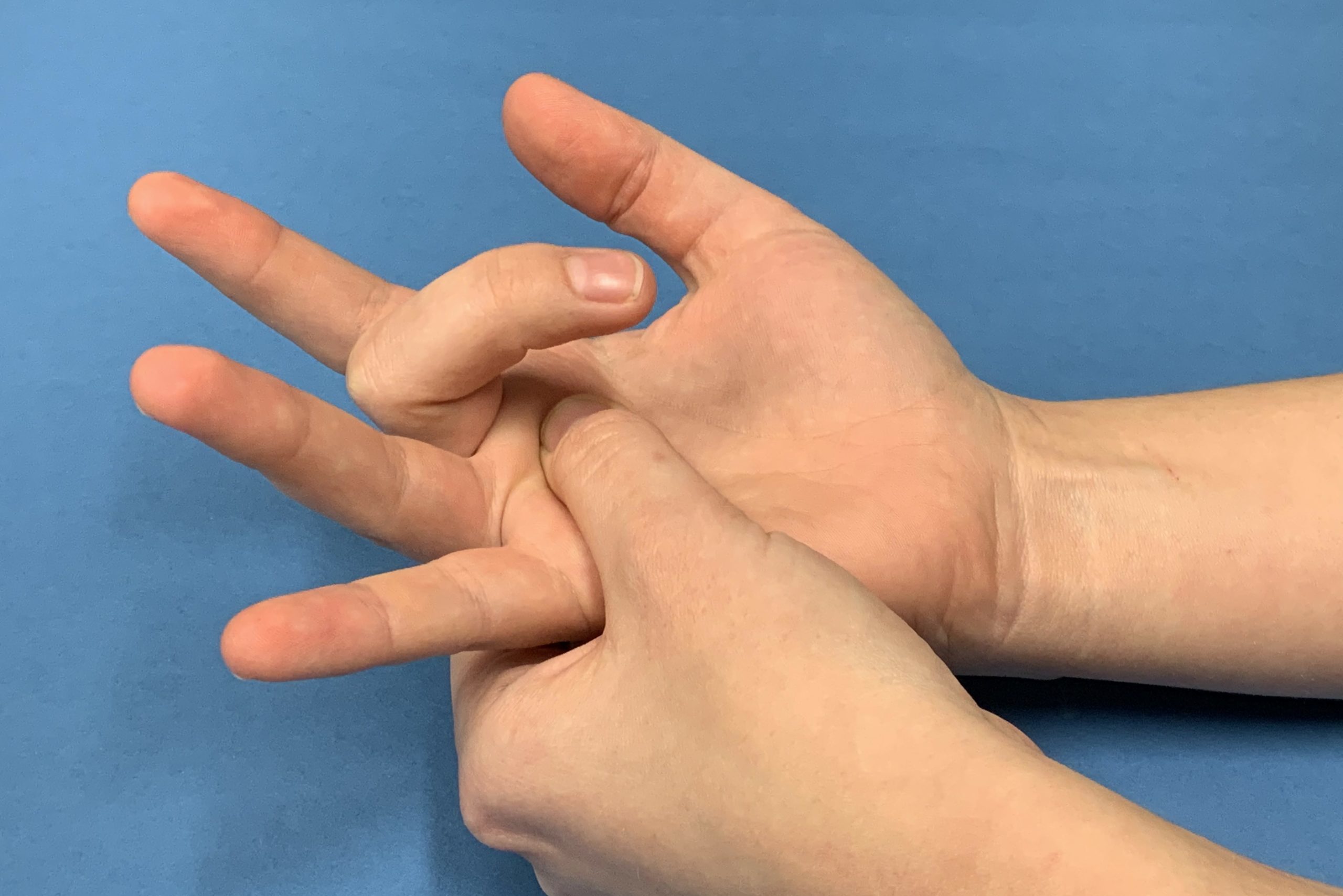 Is Trigger Thumb Common In Children Hand Therapy Group