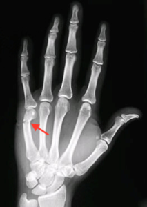 Metacarpal fracture – Hand Therapy Group