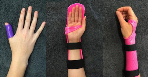 What is thermoplastic splinting? - Hand Therapy Group